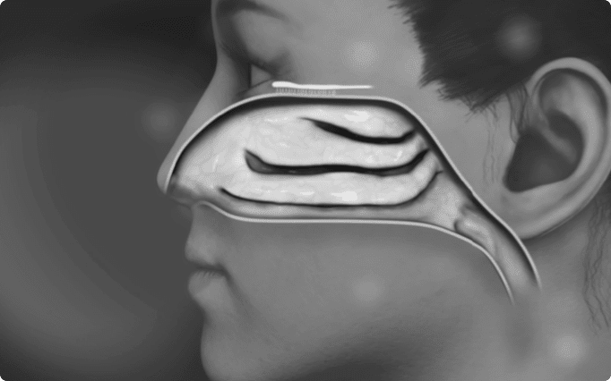 Watch video. Black and white still of a Trudhesa® video with a person looking to the left with an illustration of the upper nasal space overlayed.